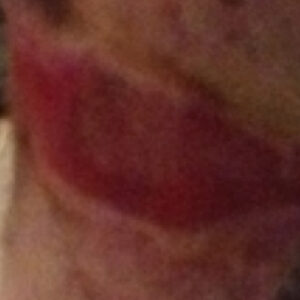 Healed wound area on horse leg