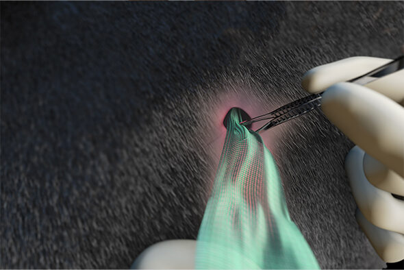 Person filling wound cavity with Sorbact Ribbon dressing using forceps